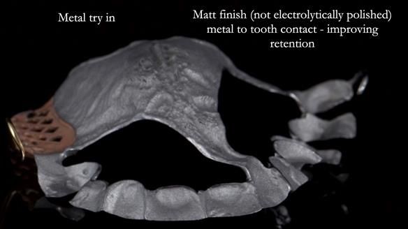 Finlay's Newsletter 64 case study - provision of a Kennedy class 2 metal based Scandinavian RPD for Ian