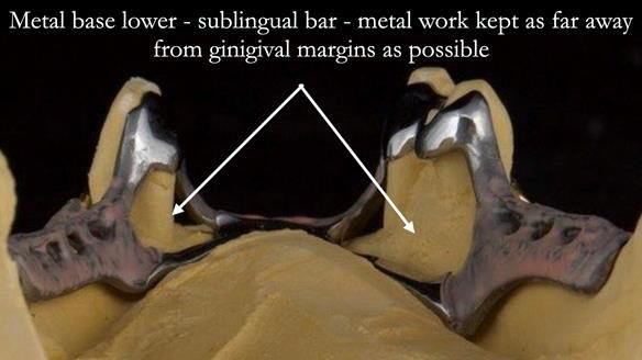 Finlay's Case Study Newsletter 40 - Immediate Mk 1 RPD to Definitive Mk 2 RPD - full protocol
