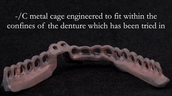 Managing poor implant positioning with complete dentures and Locator attachments - full protocol Newsletter 41