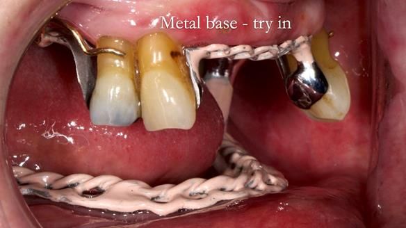 Finlay's Newsletter 59 Ultra hard partial dentures made for Gill