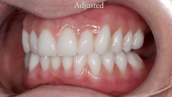 Newsletter 65 Marisa Provision of Complete Dentures on badly placed implants