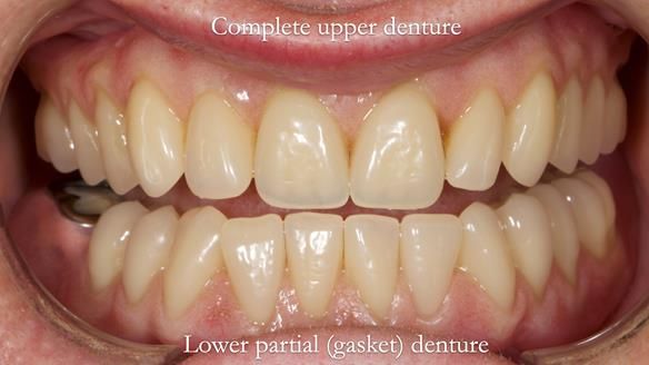 Newsletter 82 Mary - A complete upper and a one-tooth gasket denture