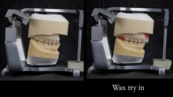 Upper metal base partial denture/occlusal stabilisation splint/obturator - full protocol
