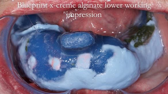 Newsletter 55 Provision of metal based partial dentures for Zephyrine with a repaired cleft lip and palate