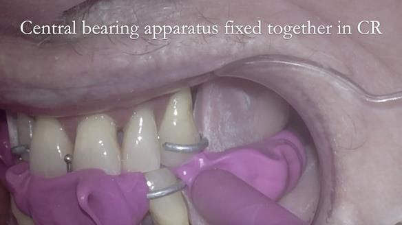 Finlay's Case Study Newsletter 40 - Immediate Mk 1 RPD to Definitive Mk 2 RPD - full protocol