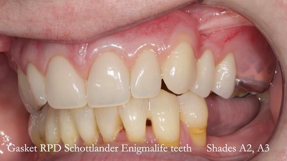 Finlay's Newsletter 58 Gasket upper partial denture for Zoe