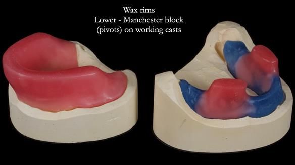 Newsletter 75: Marion’s case - Step-by-step complete denture workflow