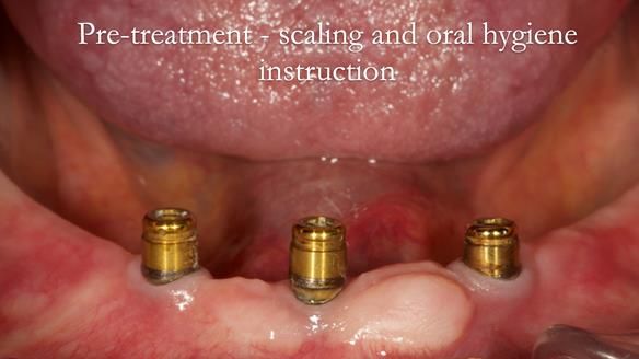 Following scaling and oral hygiene instruction