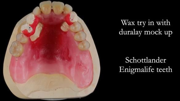 Finlay's Newsletter 59 Ultra hard partial dentures made for Gill