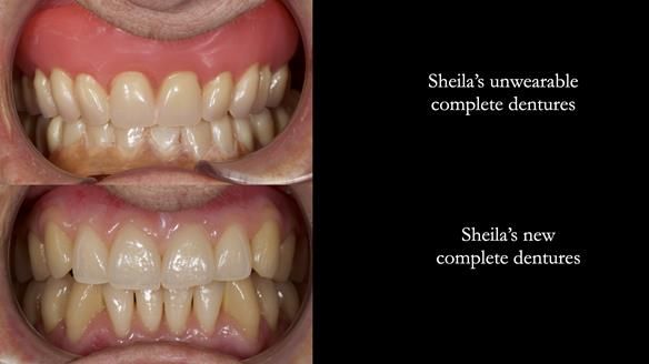 Newsletter 83: Sheila’s Complete Denture Success