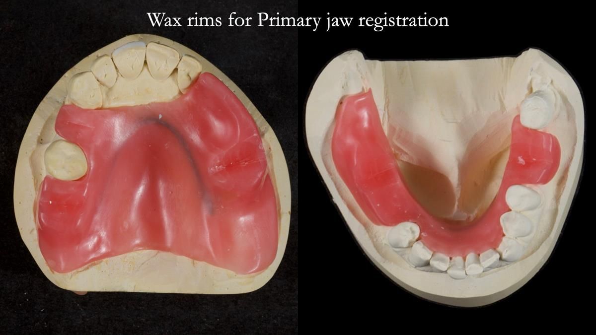 Newsletter 89 – Simon: A Challenging Kennedy Class II Division 1 Upper CoCr Partial Denture with a High Smile Line