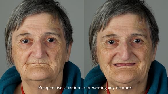 Newsletter 83: Sheila’s Complete Denture Success