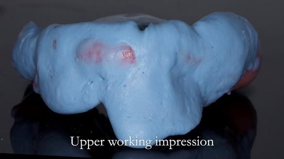 Eileen's transformation with upper and lower RPDs of Scandinavian hygienic design FULL PROTOCOL