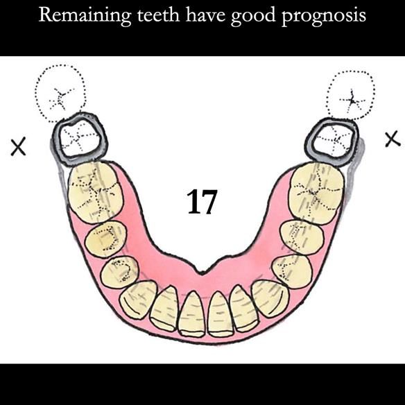 Universal Scandinavian partial denture designs