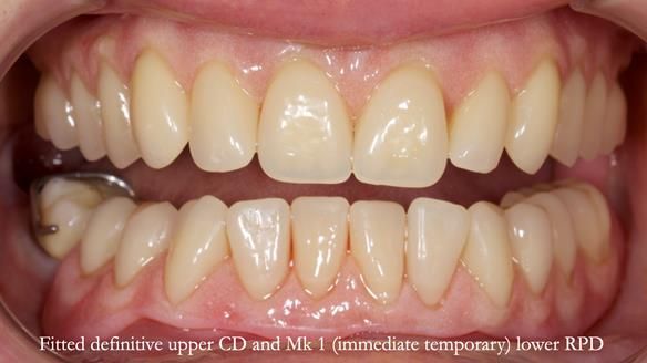 Newsletter 82 Mary - A complete upper and a one-tooth gasket denture