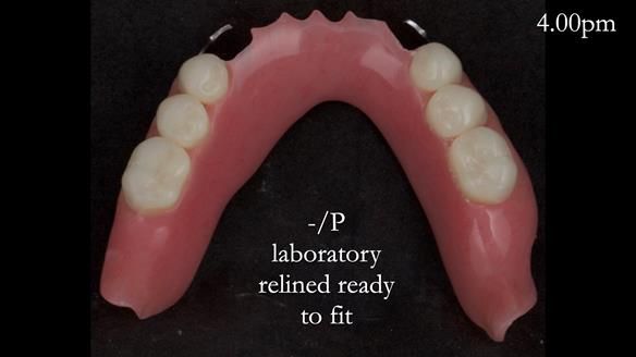 Newsletter 52 Managing Jo’s failing dentition with extractions and Mk 1/Mk 2 complete upper dentures and lower partial dentures FULL PROTOCOL