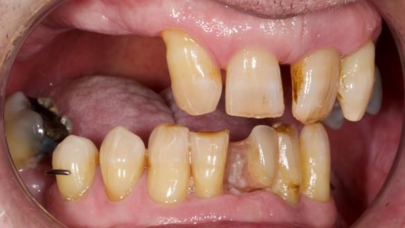 Newsletter 86 Peter the Architect — precision removable partial dentures case study