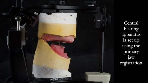 Central bearing apparatus - gothic arch tracing system - set up on the working casts which have mounted using the primary jaw registration