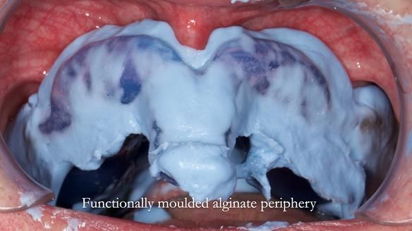 Newsletter 77: Jeremy’s case – immediate complete upper denture
