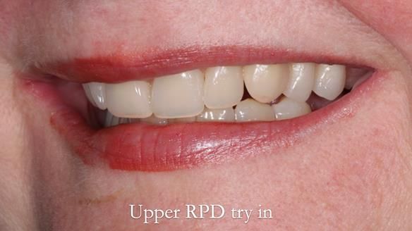 Finlay's Newsletter 58 Gasket upper partial denture for Zoe