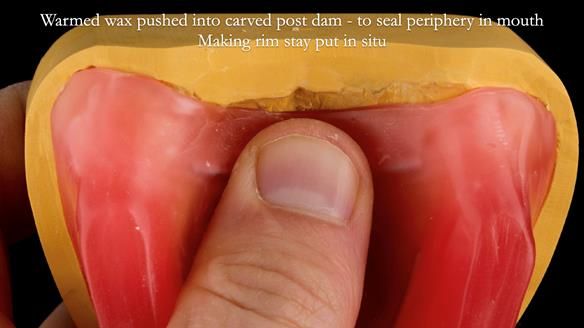 Newsletter 80 - Gordon’s dentures: the one case in 1,000 where my technique failed