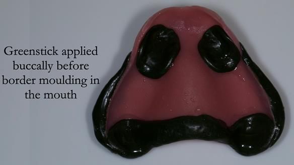 Newsletter 54 case presentation upper complete denture and lower Scandinavian designed hygienic partial denture for David