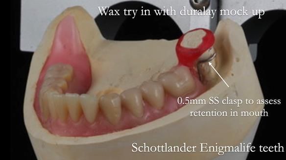 Finlay's Newsletter 59 Ultra hard partial dentures made for Gill