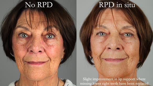 Finlay's Newsletter 61 provision of a lower unilateral free end saddle metal based partial denture for Joyce