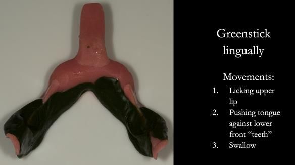 Greenstick right - right and left lingually from second molar to second molar – avoiding the retromolar pad - this is moulded in the patients mouth by the patient licking the upper lip from right to left commissures, pushing the tongue against the lower 