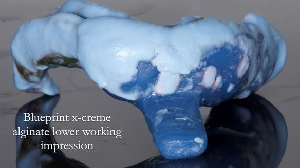 Newsletter 55 Provision of metal based partial dentures for Zephyrine with a repaired cleft lip and palate