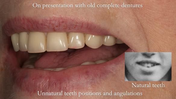 Newsletter 75: Marion’s case - Step-by-step complete denture workflow