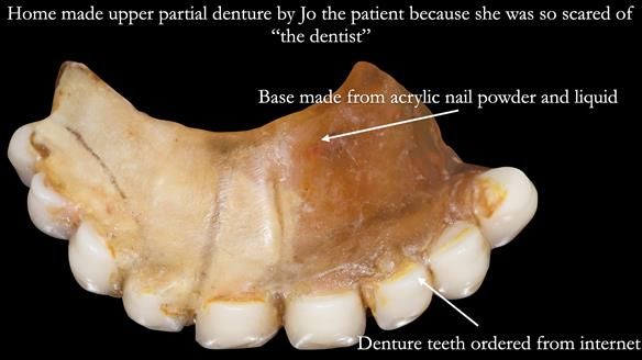 Newsletter 52 Managing Jo’s failing dentition with extractions and Mk 1/Mk 2 complete upper dentures and lower partial dentures FULL PROTOCOL