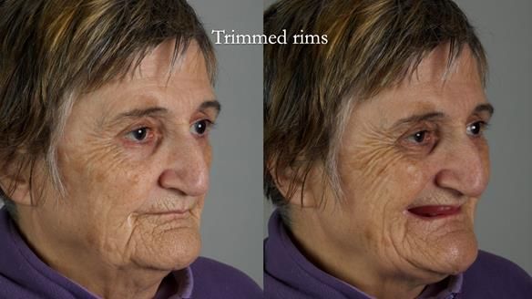 Newsletter 83: Sheila’s Complete Denture Success