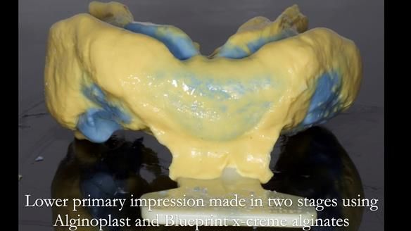 Newsletter 57 showcases the making and fitting process of implant-supported complete dentures for Alisdair