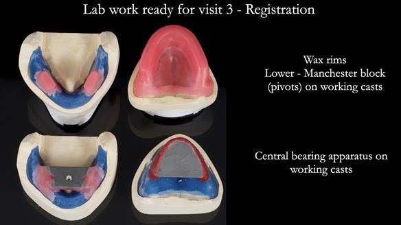 Newsletter 80 - Gordon’s dentures: the one case in 1,000 where my technique failed