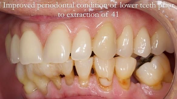 Newsletter 54 case presentation upper complete denture and lower Scandinavian designed hygienic partial denture for David
