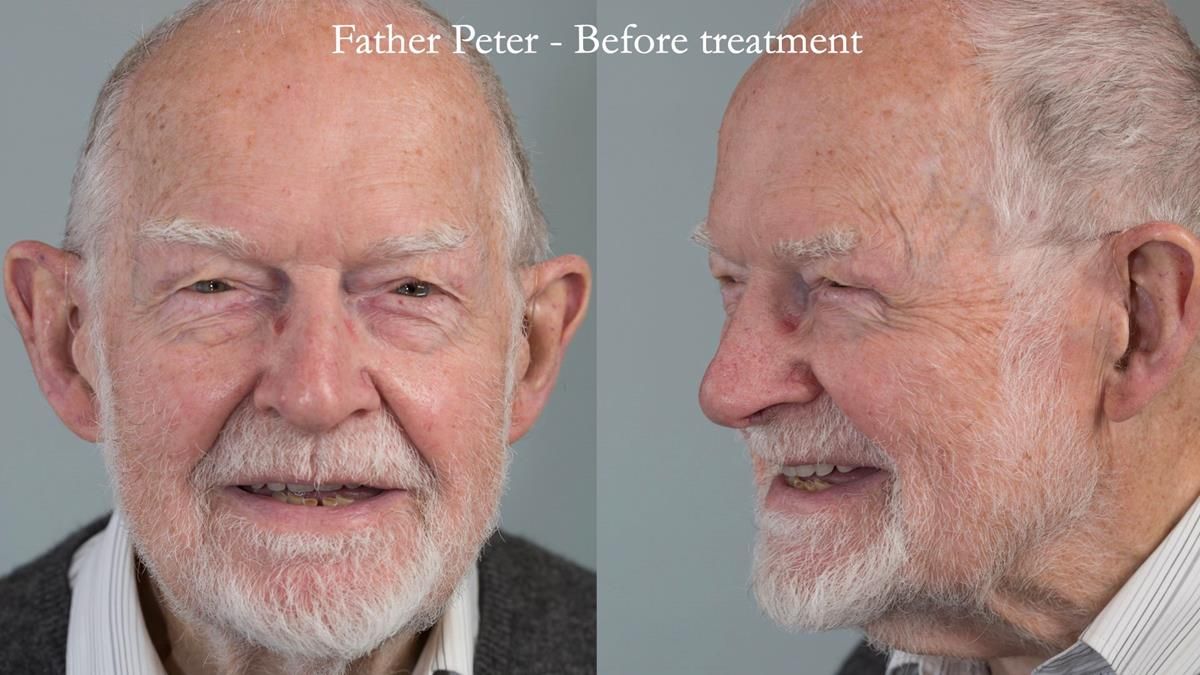 Newsletter 87 – Father Peter: A Partial Denture that needed Minor Miracle
