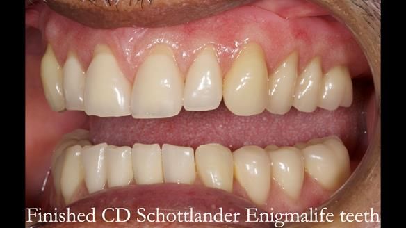 Finlay's Newsletter 62 provision of extractions and metal based complete dentures for Rafique