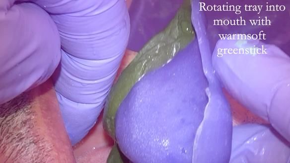 Finlay's Newsletter 62 provision of extractions and metal based complete dentures for Rafique