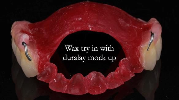 Newsletter 56 showing the making and fitting of a bilateral free end saddle upper removable partial denture (RPD) for patient with pemphigus