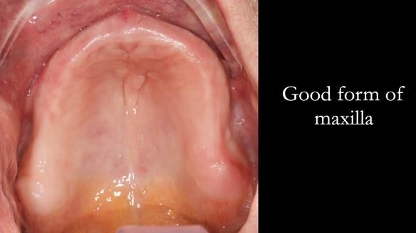 Newsletter 50 Special edition Complete Dentures FULL PROTOCOL