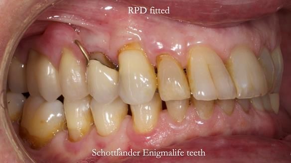 Finlay's Newsletter 64 case study - provision of a Kennedy class 2 metal based Scandinavian RPD for Ian
