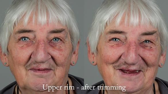Newsletter 55 Provision of metal based partial dentures for Zephyrine with a repaired cleft lip and palate