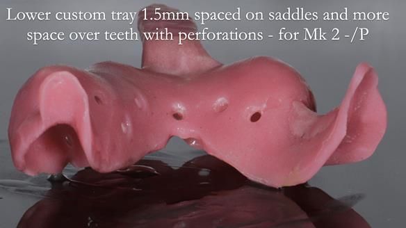 Newsletter 54 case presentation upper complete denture and lower Scandinavian designed hygienic partial denture for David