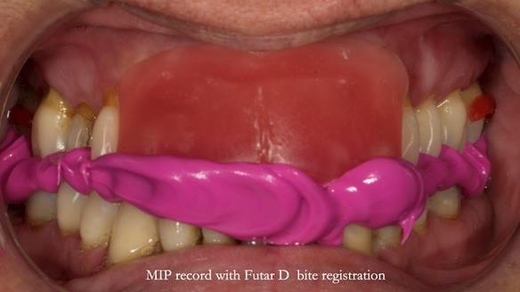 Finlay's Newsletter 63 Case study provision of metal based Scandinavian RPD - functional 10 years on