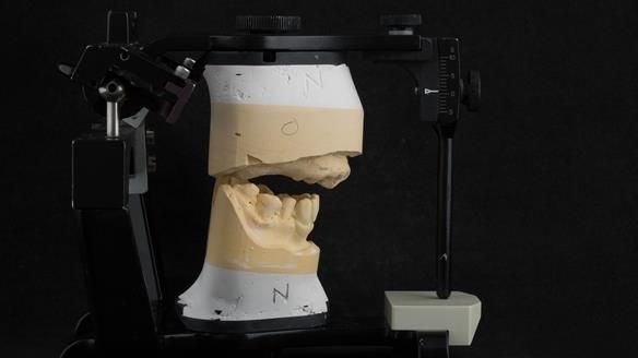 Figure 23 Mounted working cast for Mk 1 immediate denture. Teeth removed from cast - minimal preparation of the cast to reduce adjustments at fit
