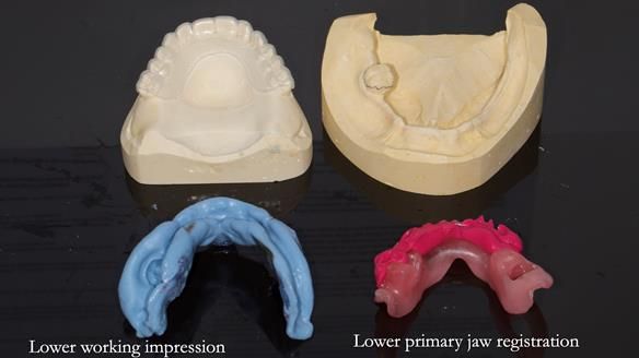 Newsletter 82 Mary - A complete upper and a one-tooth gasket denture