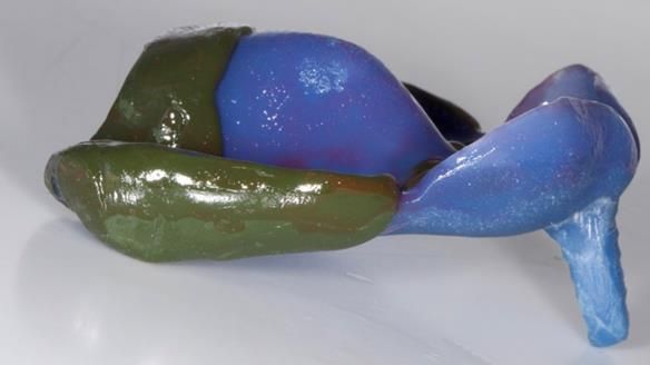 Newsletter 77: Jeremy’s case – immediate complete upper denture