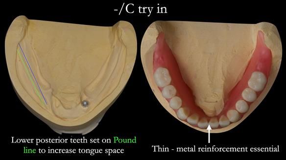 Managing poor implant positioning with complete dentures and Locator attachments - full protocol Newsletter 41