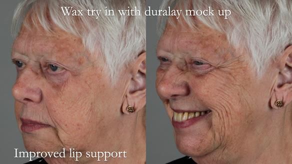Finlay's Newsletter 59 Ultra hard partial dentures made for Gill
